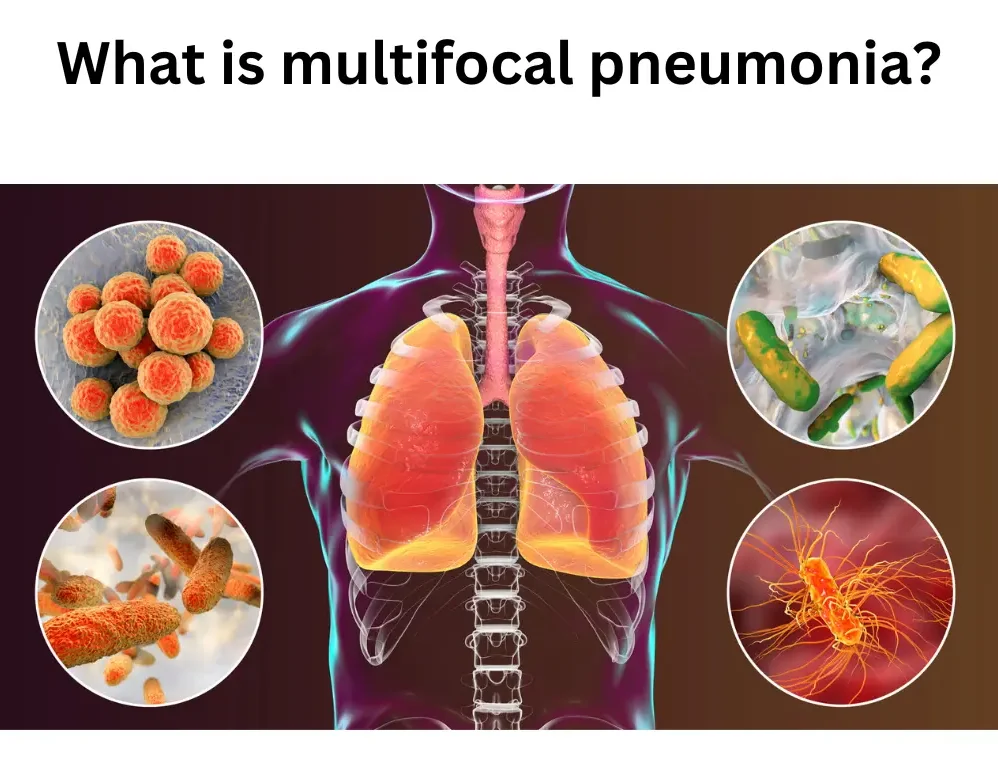 multifocal pneumonia